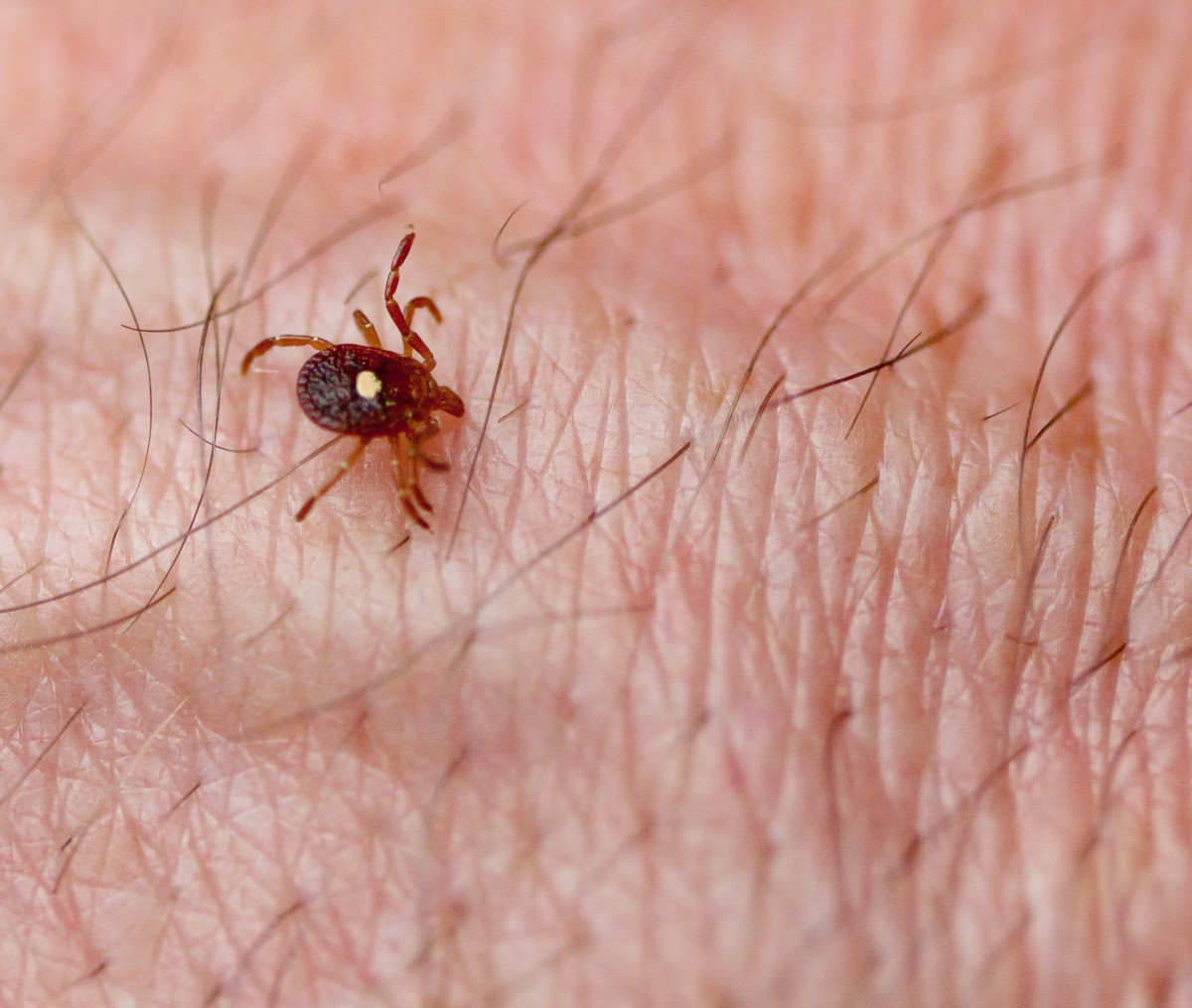 Meat Allergy From Tick Bites on the Rise